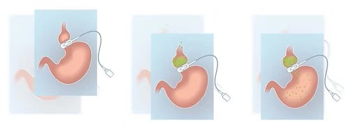 Anneau gastrique gastroplastie Tunisie